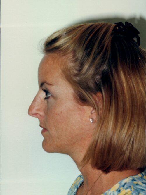 Rhinoplasty Patient 15 - Before - 1