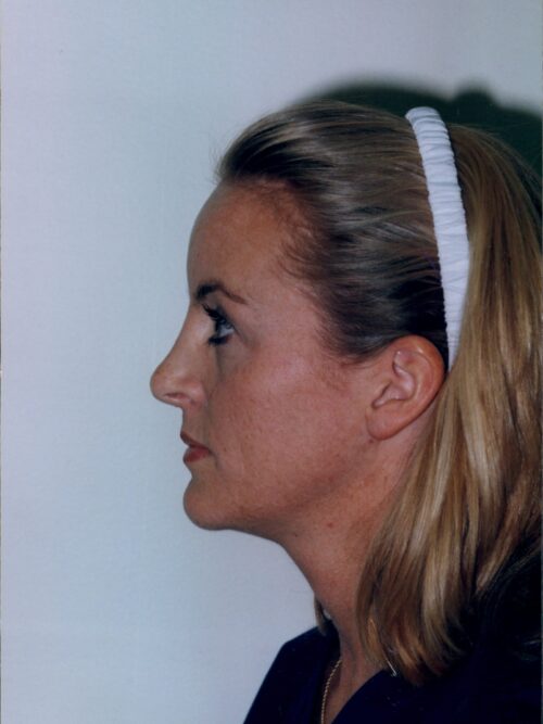 Rhinoplasty Patient 15 - After - 1