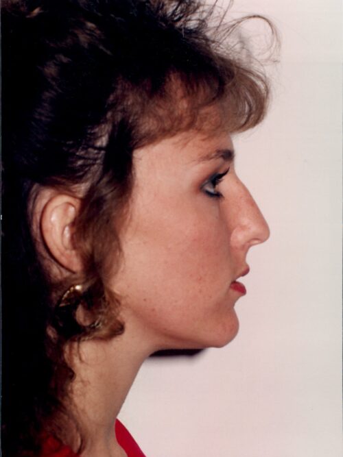 Rhinoplasty Patient 14 - Before - 1