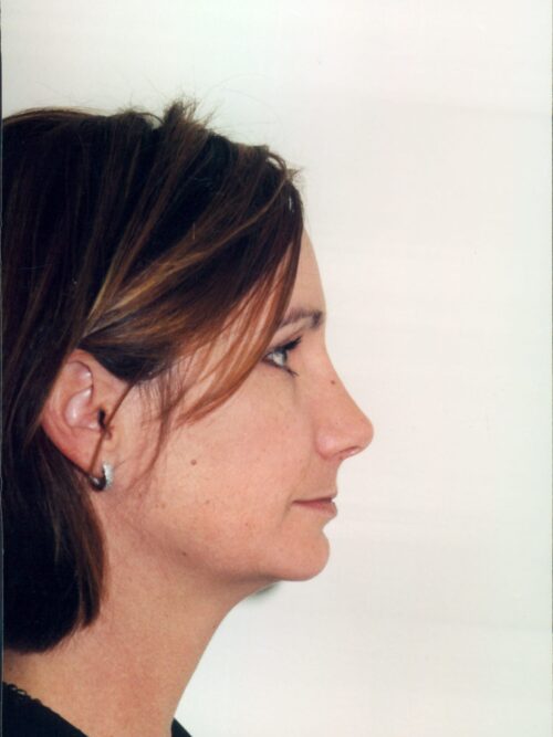 Rhinoplasty Patient 13 - After - 1