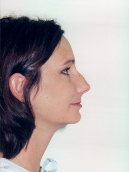 Rhinoplasty Patient 13 - Before - 1