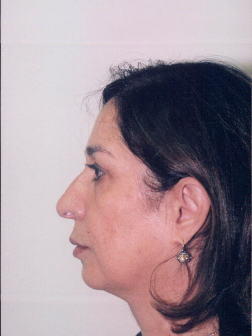 Rhinoplasty Patient 31 - Before - 1