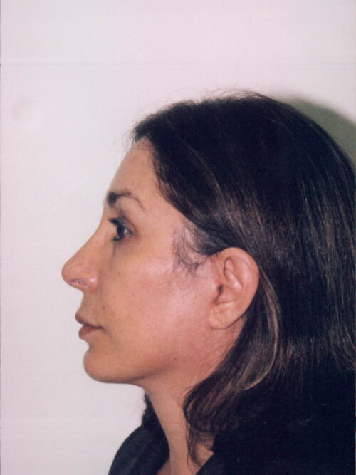 Rhinoplasty Patient 31 - After - 1