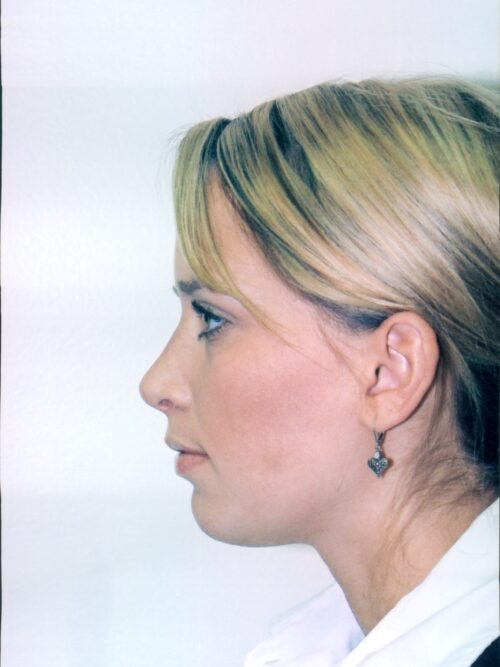 Rhinoplasty Patient 12 - After - 1