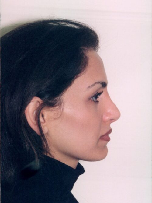 Rhinoplasty Patient 10 - After - 1