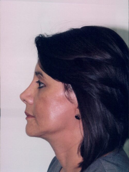 Rhinoplasty Patient 09 - After - 1