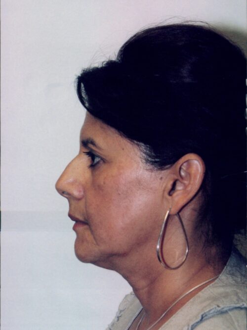 Rhinoplasty Patient 09 - Before - 1