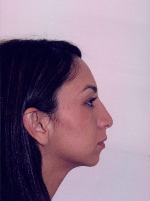 Rhinoplasty Patient 07 - Before - 1