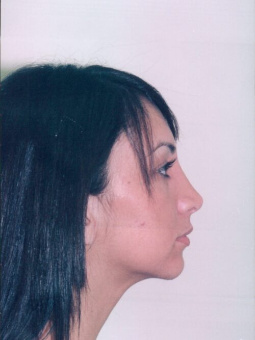 Rhinoplasty Patient 07 - After - 1