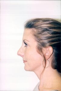 Rhinoplasty Patient 03 - Before - 2 Thumbnail