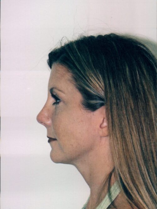 Rhinoplasty Patient 03 - After - 2