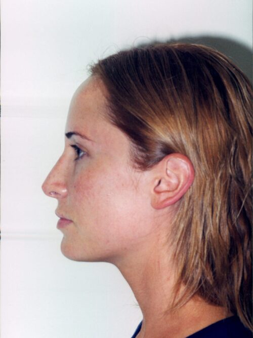 Rhinoplasty Patient 05 - After - 1