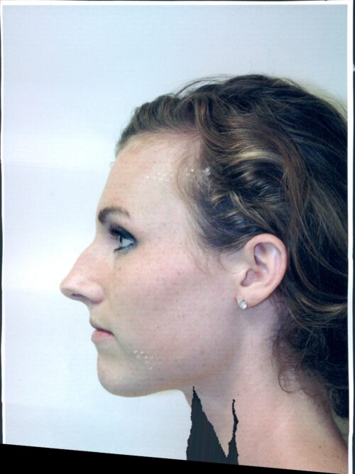 Rhinoplasty Patient 06 - Before - 1