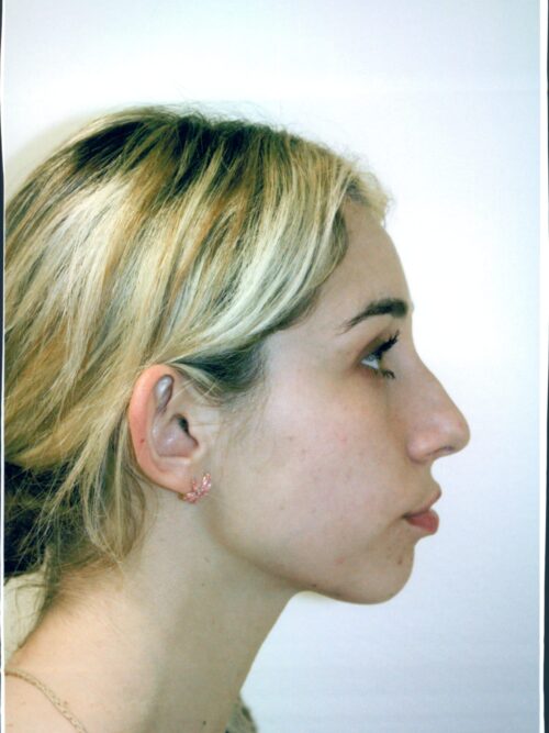 Rhinoplasty Patient 20 - Before - 1