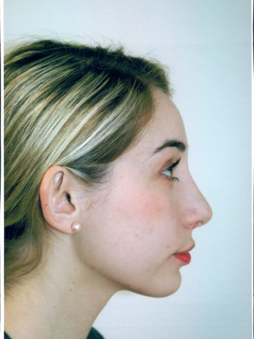 Rhinoplasty Patient 20 - After - 1