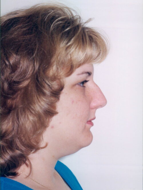 Rhinoplasty Patient 02 - Before - 1