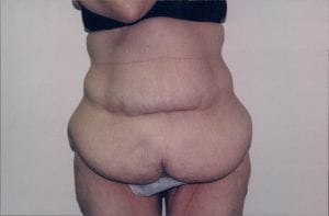 Tummy Tuck Patient 16 - Before - 1 Thumbnail