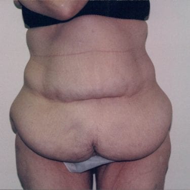 Tummy Tuck Patient 16 - Before - 1