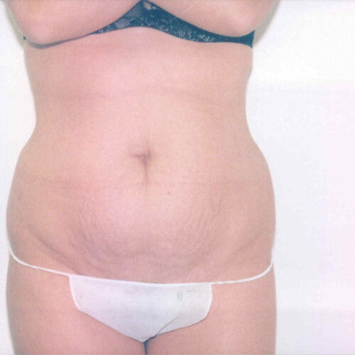 Tummy Tuck Patient 01 - Before - 1