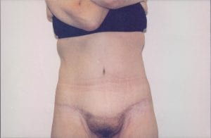 Tummy Tuck Patient 16 - After - 1 Thumbnail