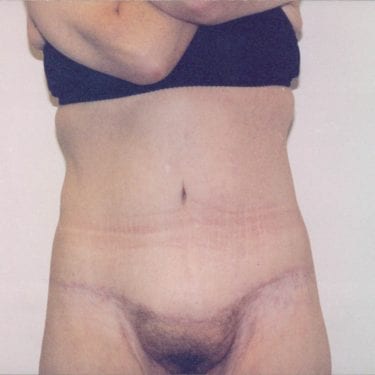 Tummy Tuck Patient 16 - After - 1