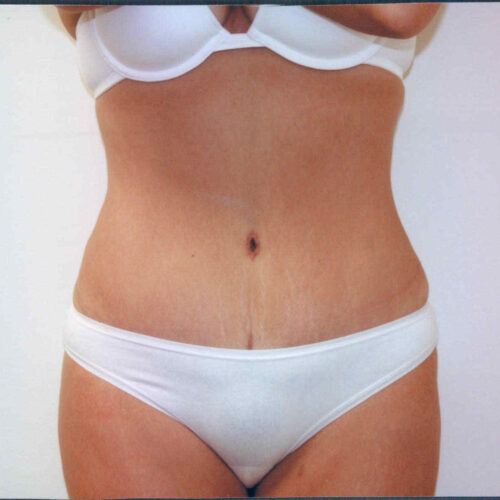 Tummy Tuck Patient 01 - After - 1