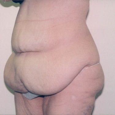 Tummy Tuck Patient 16 - Before - 2