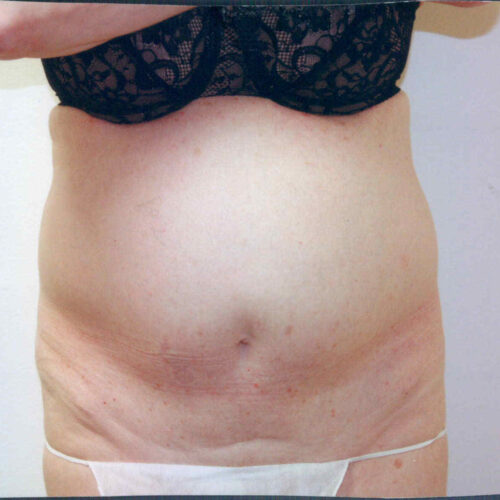 Tummy Tuck Patient 02 - Before - 1