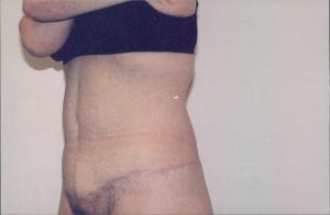 Tummy Tuck Patient 16 - After - 2 Thumbnail