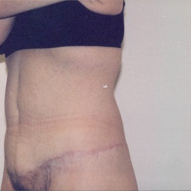Tummy Tuck Patient 16 - After - 2