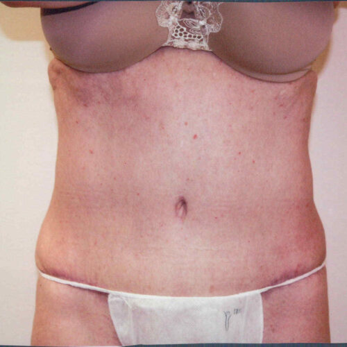 Tummy Tuck Patient 02 - After - 1