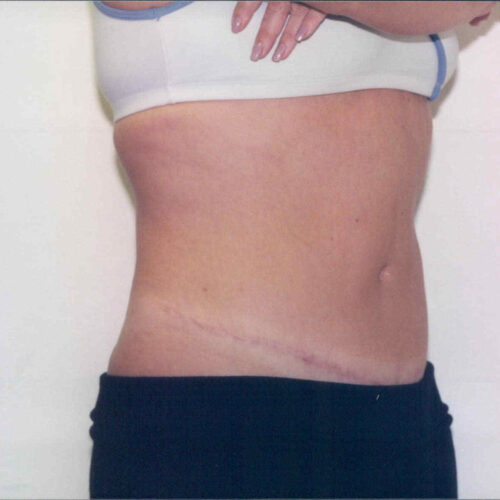 Tummy Tuck Patient 03 - After - 1