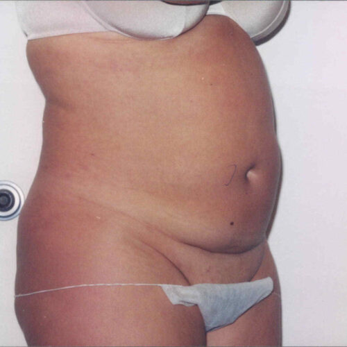 Tummy Tuck Patient 03 - Before - 1