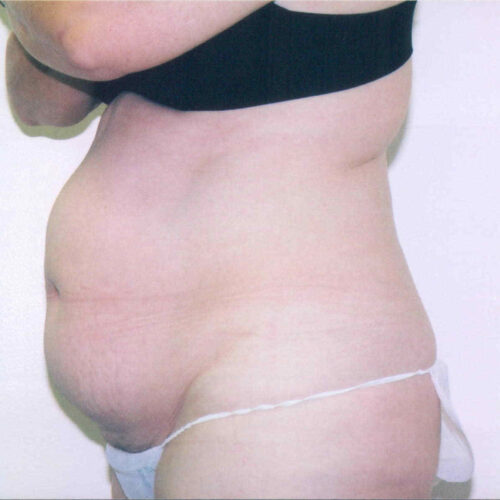 Tummy Tuck Patient 04 - Before - 1