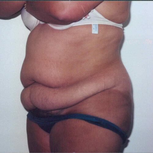 Tummy Tuck Patient 05 - Before - 1