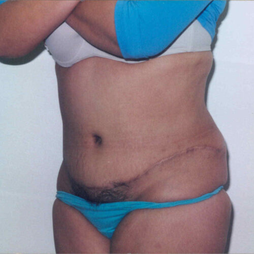Tummy Tuck Patient 05 - After - 1