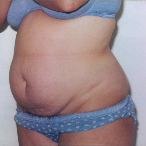 Tummy Tuck Patient 06 - Before - 1