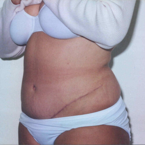 Tummy Tuck Patient 06 - After - 1