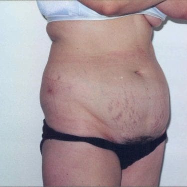 Tummy Tuck Patient 07 - Before - 1