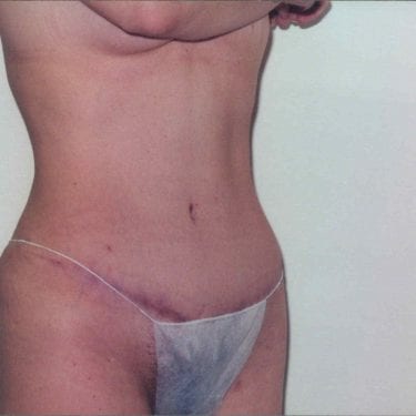 Tummy Tuck Patient 07 - After - 1