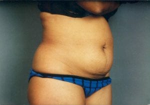 Tummy Tuck Patient 08 - Before - 1 Thumbnail