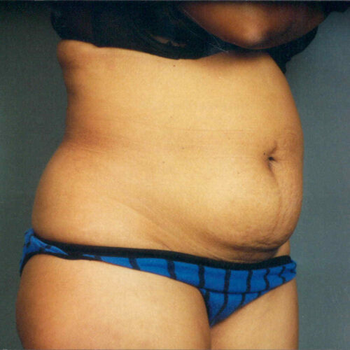 Tummy Tuck Patient 08 - Before - 1