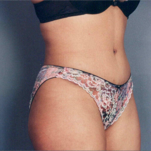 Tummy Tuck Patient 08 - After - 1