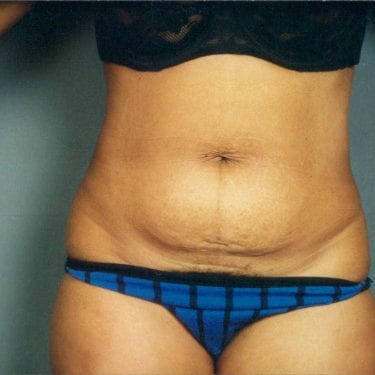 Tummy Tuck Patient 08 - Before - 2