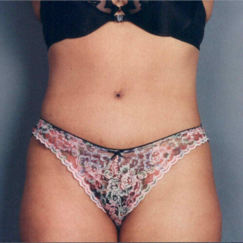 Tummy Tuck Patient 08 - After - 2