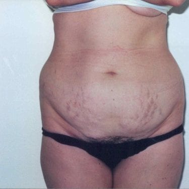 Tummy Tuck Patient 09 - Before - 1