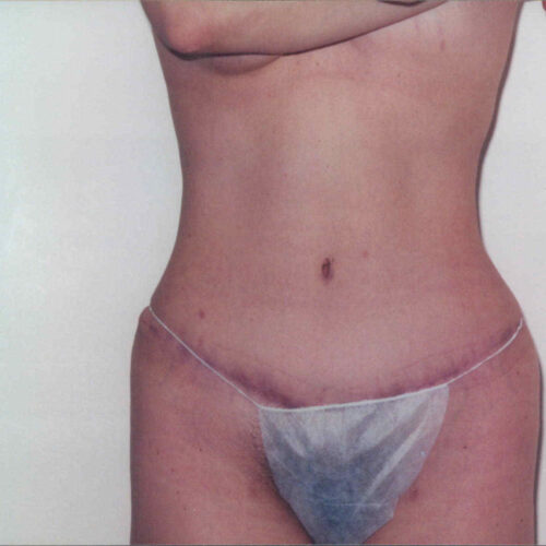 Tummy Tuck Patient 09 - After - 1
