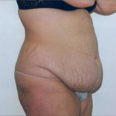 Tummy Tuck Patient 10 - Before - 1