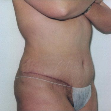 Tummy Tuck Patient 10 - After - 1