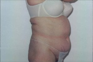 Tummy Tuck Patient 11 - Before - 1 Thumbnail